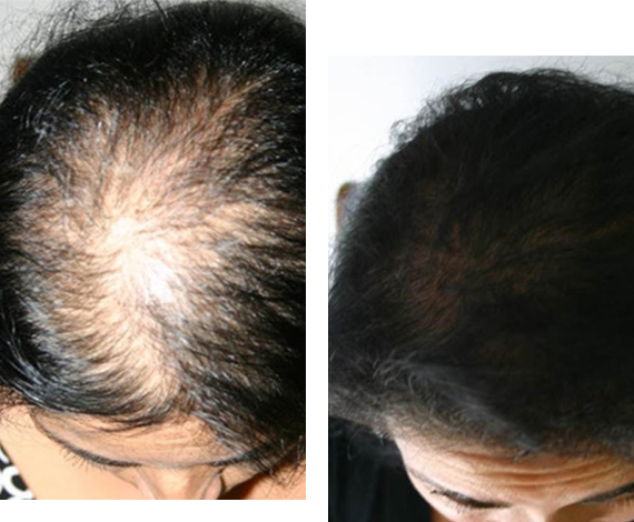 Hair Patch Repair Center in Bangalore