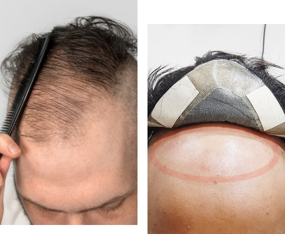 Hair Replacement Center in Bangalore